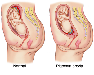 placenta-prévia